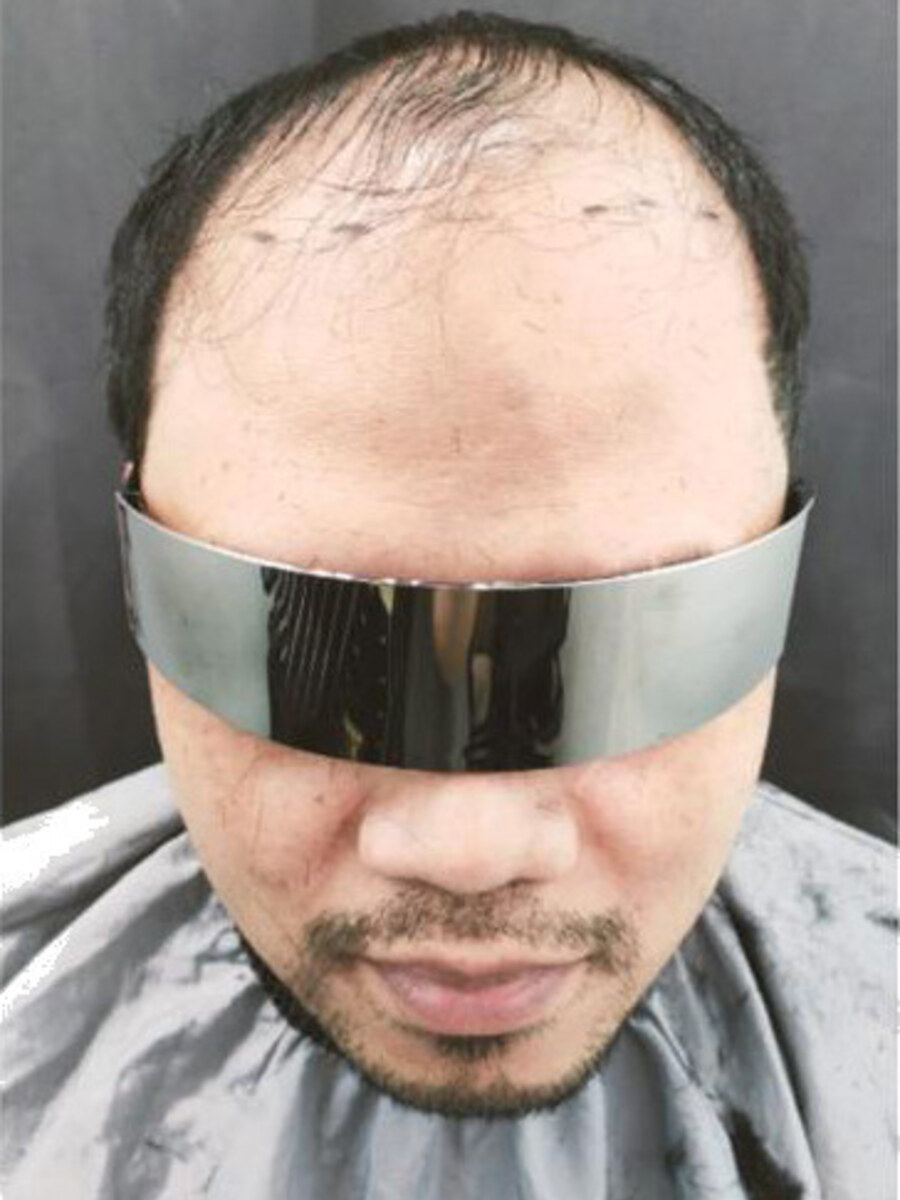 Client before a Roots Care hair system