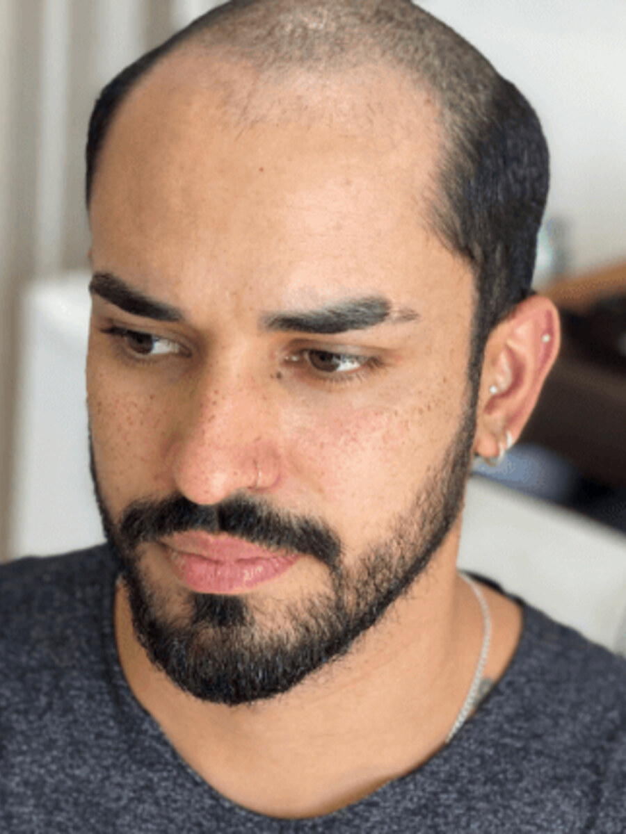 Roots Care client before a hair replacement system